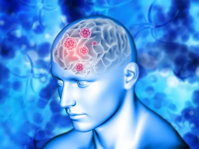 vascular brain diseases, vascular brain diseases treatment in indore, brain disease treatment in indore, brain surgery in indore
