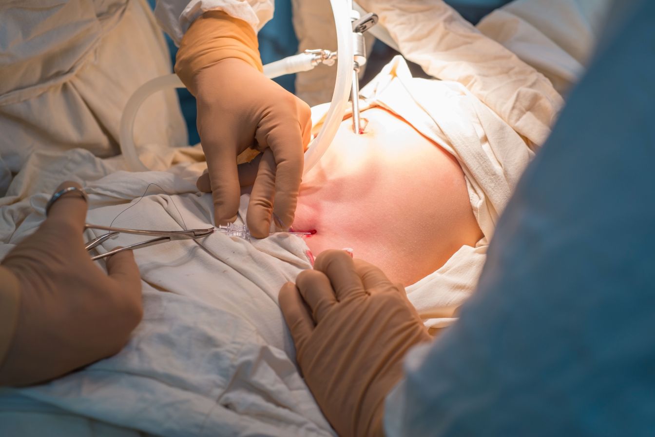 Endoscopic spine surgery in Indore showing minimally invasive spinal procedure