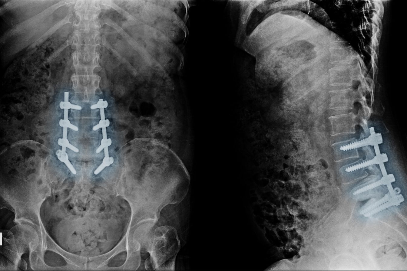 Lumbar microdiscectomy in Indore showing spine surgery with fixation and disc treatment