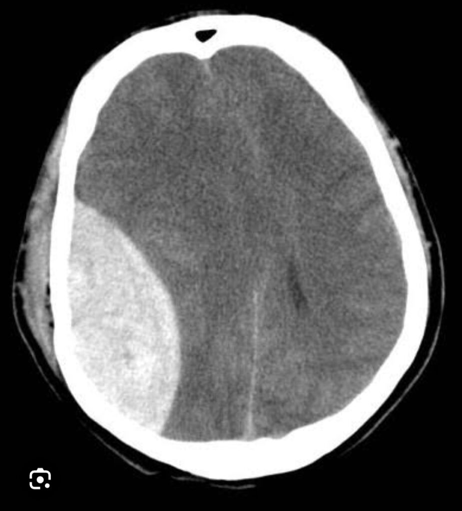 CT scan showing brain hemorrhage after road traffic accident treated by neurosurgeon in Indore