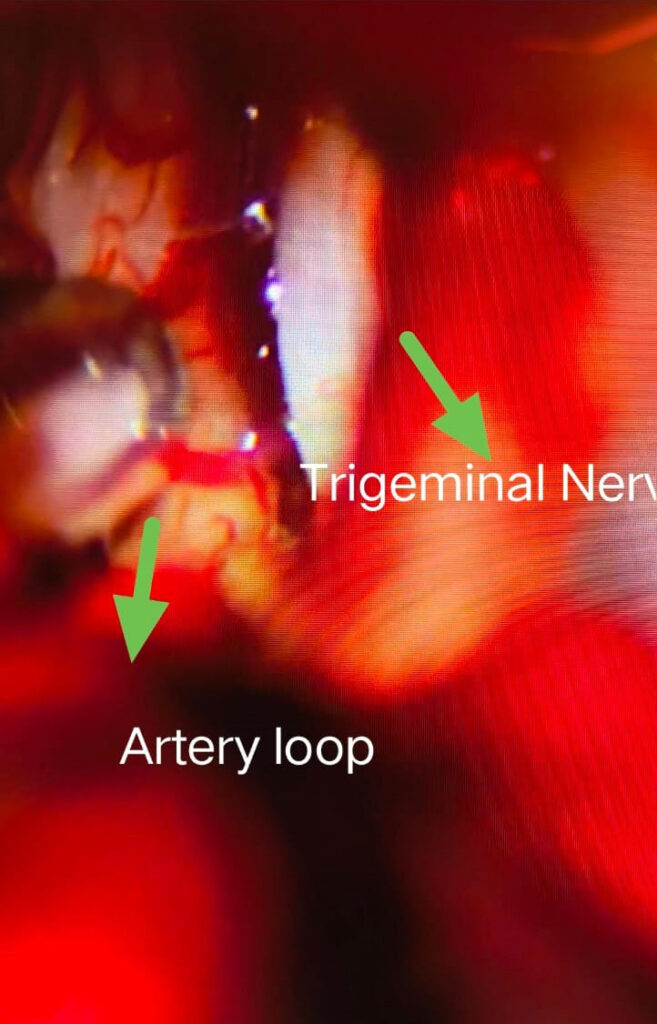 Trigeminal neuralgia surgery showing artery loop compressing trigeminal nerve treated by neurosurgeon in Indore