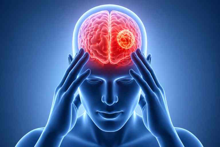Brain tumor illustration showing head pain and neurological condition treated by neurosurgeon in Indore
